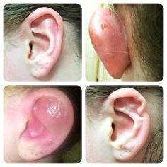 Príklady nepodareného prepichnutie ucha